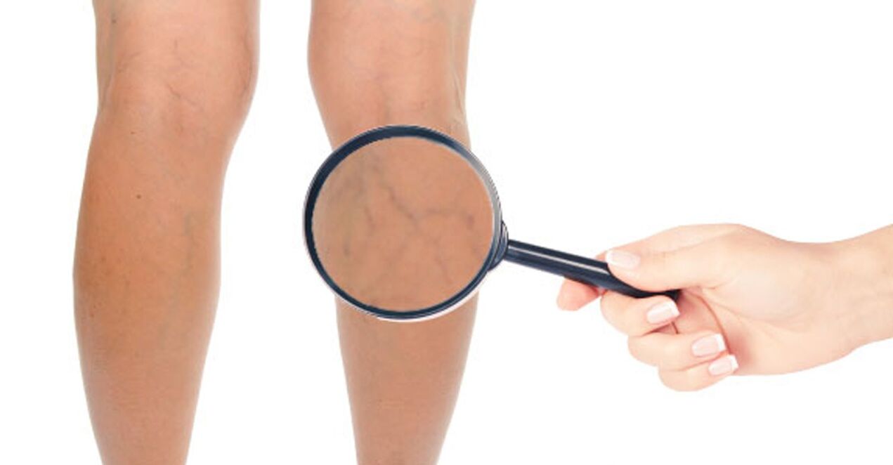 Ursachen von Krampfadern